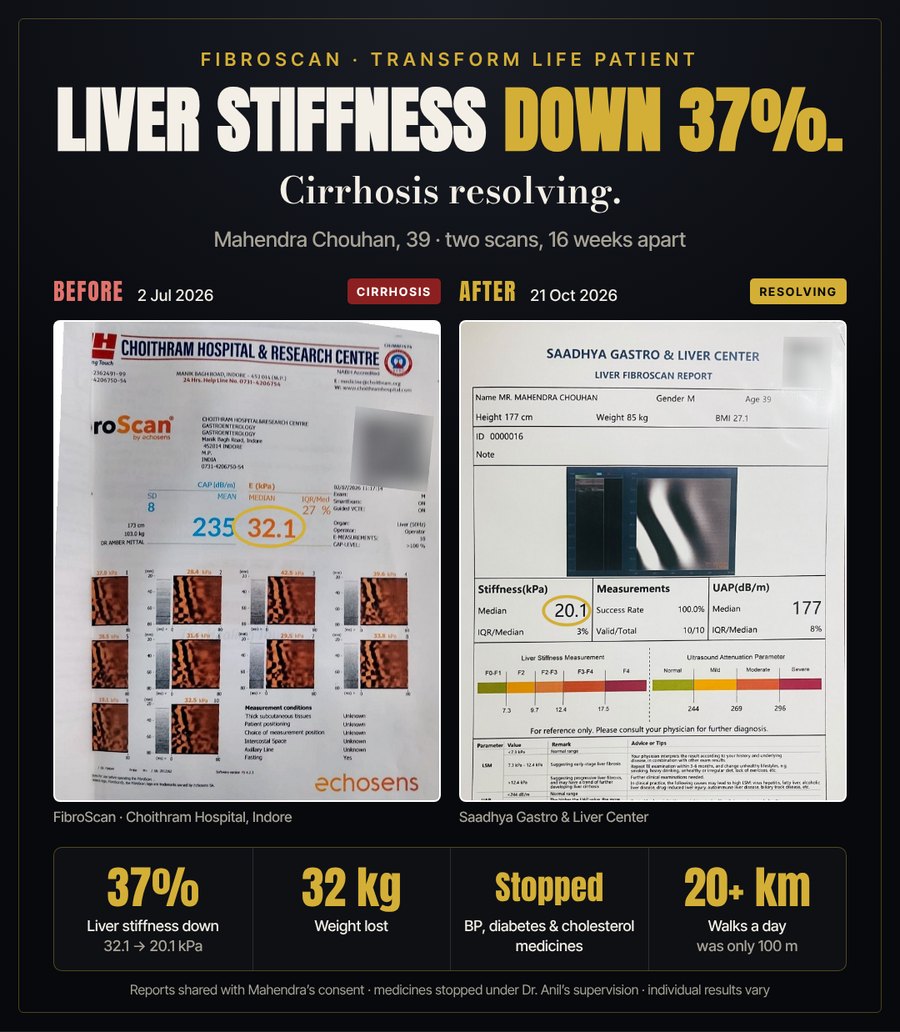Two liver scan reports for Mahendra Chouhan, 39: liver stiffness 32.1 kPa on 2 July 2026 at Choithram Hospital, Indore, and 20.1 kPa on 21 October 2026 at Saadhya Gastro and Liver Center